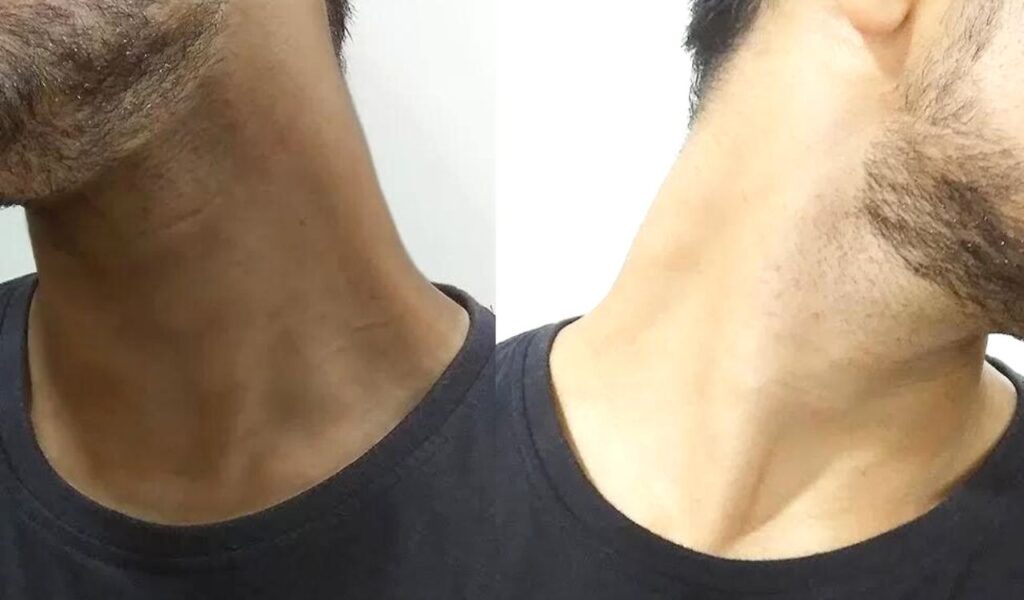 Home remedies for dark neck