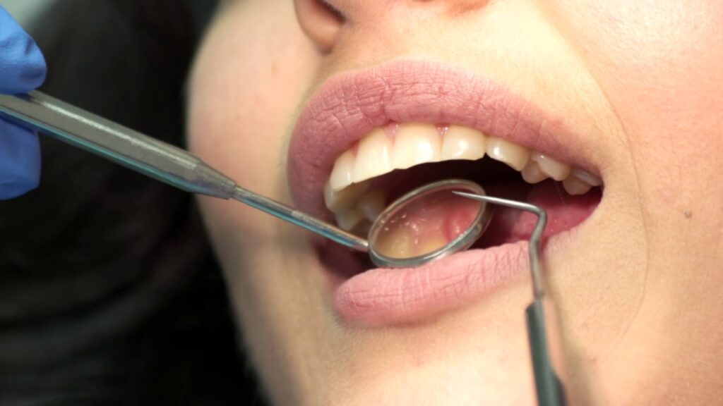 Teeth Cavity