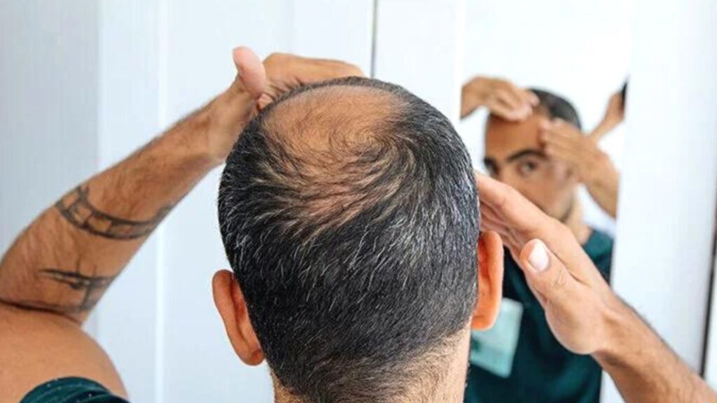 Hair Loss