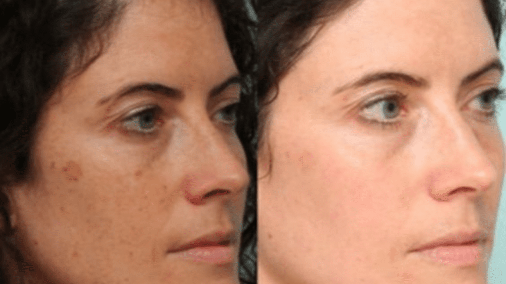 Dark Spots Removal