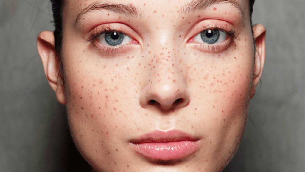 Freckles Remove