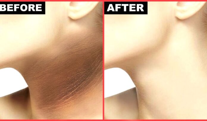 Home remedies for dark neck