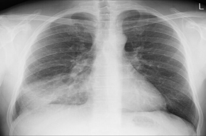 Pneumonia disease