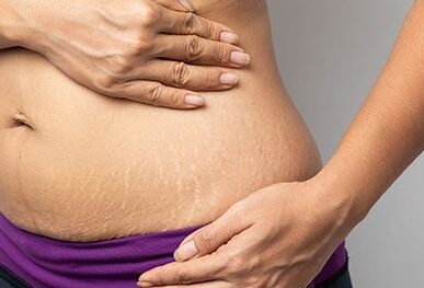 Stretch marks: