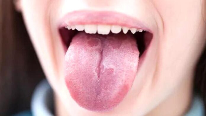 Tongue reveals health(Image source-Google)