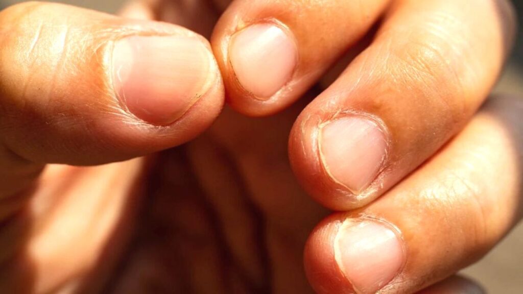 Nails tell health(Image source-Google)