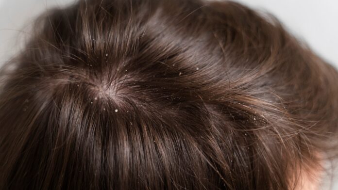 Dandruff home Remedies