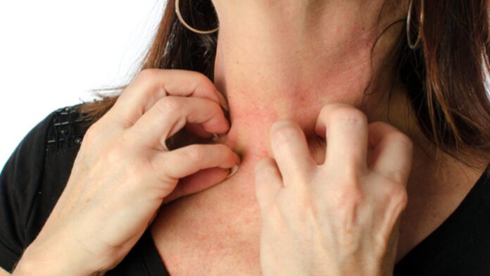Sign Of Eczema: