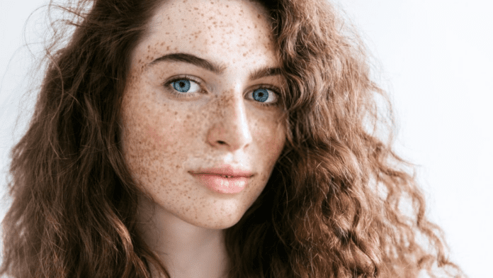 Freckles Remove