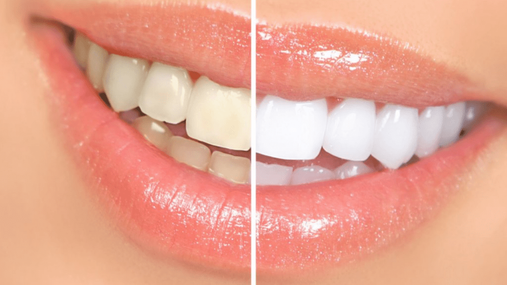 Teeth whitening Tips