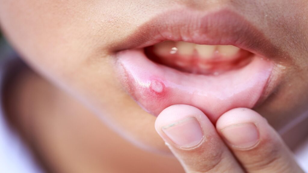 Mouth Ulcer Remedies