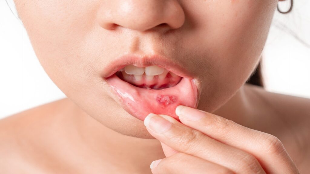 Mouth Ulcers