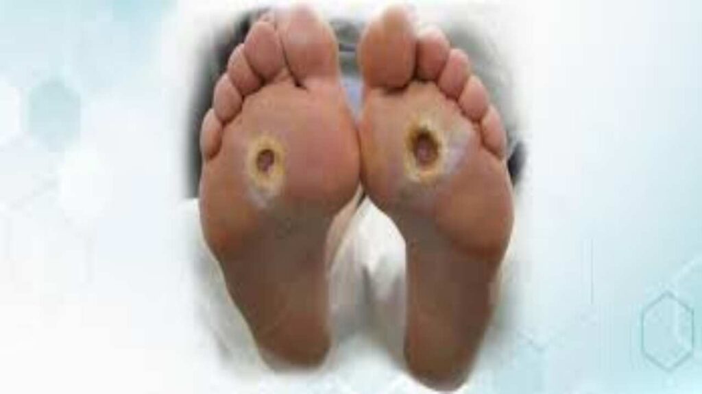Ulcers On Feet