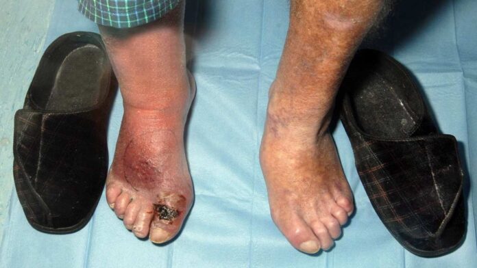 Ulcers on Feet