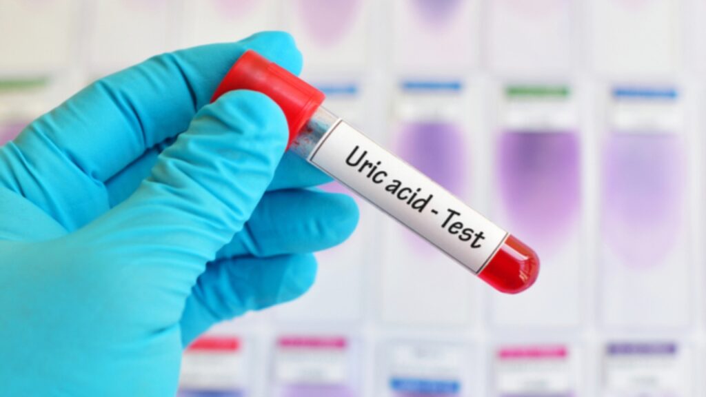 Uric Acid Checkup